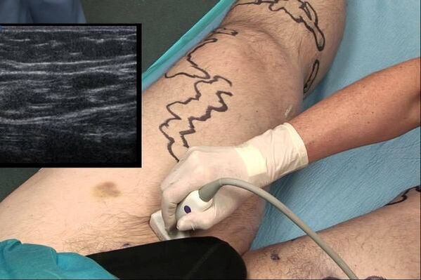 visszér diagnosztizálása férfiaknál