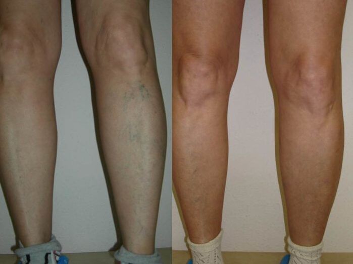 lábak visszér lézeres kezelése előtt és után