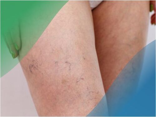 A lábakon lévő érhálózat a varikózis egyik tünete