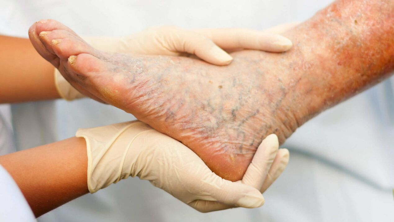 A phlebológus a lábak visszéreinek kezelésével foglalkozik