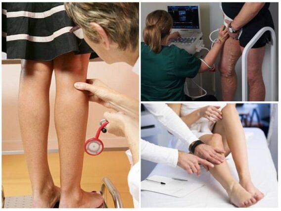 A varikoosák diagnosztizálása